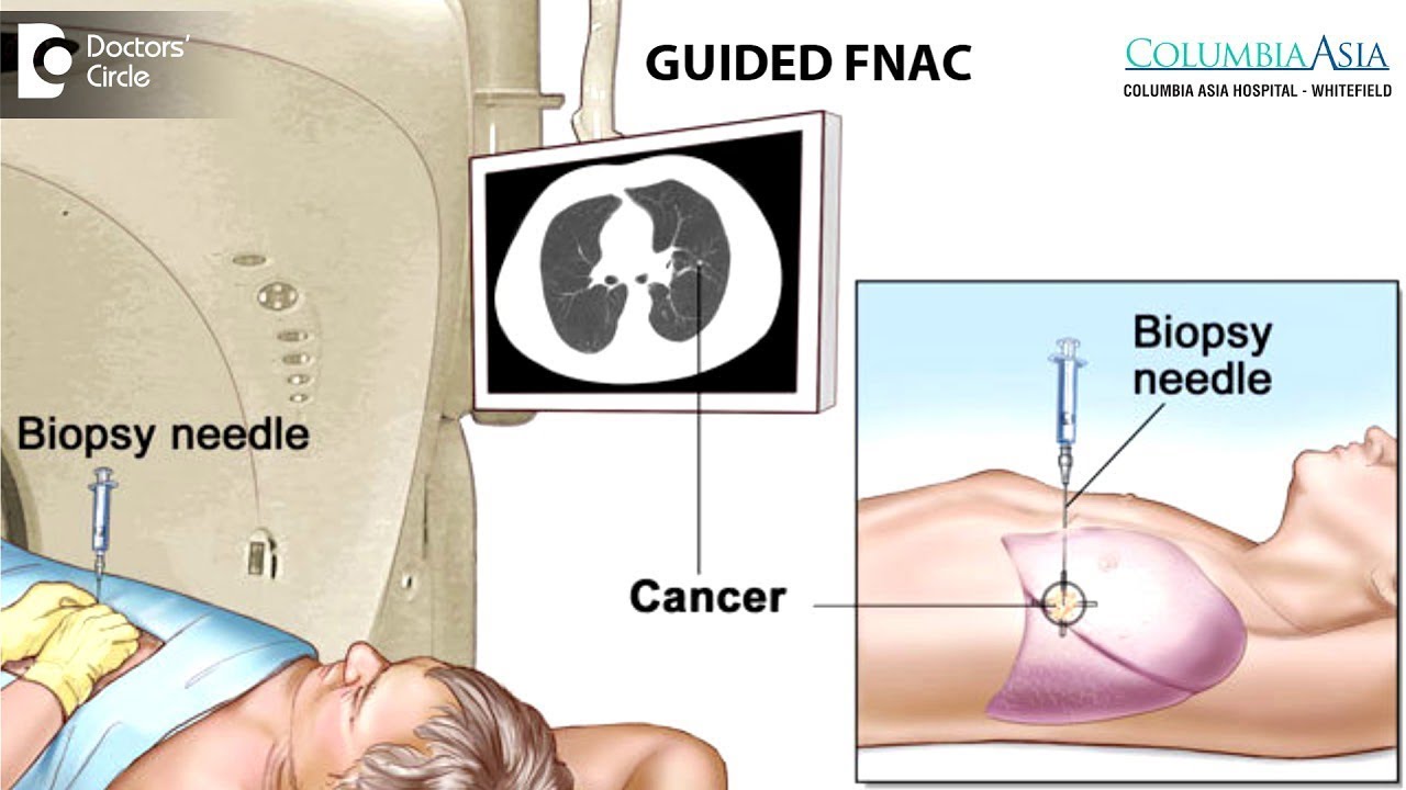 interventional-radiology-purwanchal-cancer-hospital